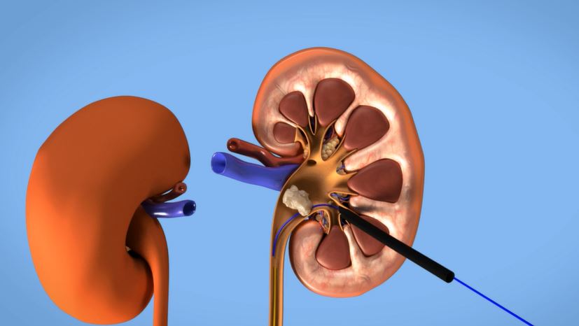 RIRS ve PCNL